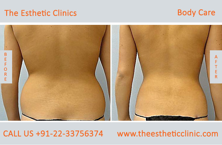body care laser treatment before after photos in mumbai india (5)